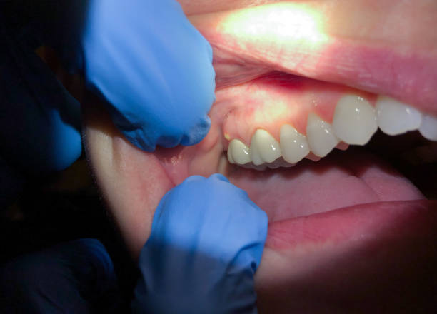 Best Emergency Treatment for Oral Infections in Sherrill, NY
