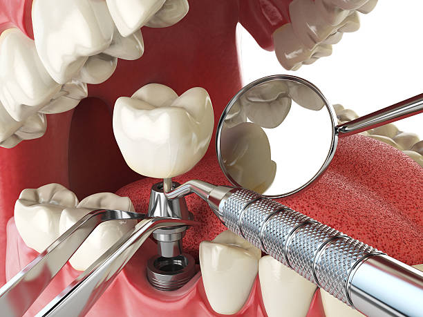 Best Emergency Wisdom Tooth Extraction in Sherrill, NY